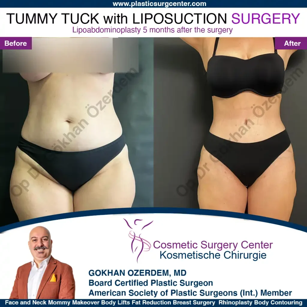 Tummy tuck in Turkey - Case 10 - Front View