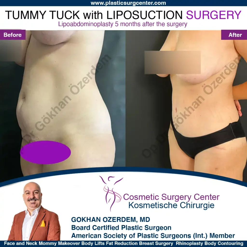 Tummy tuck in Turkey - Case 10 - Oblique View