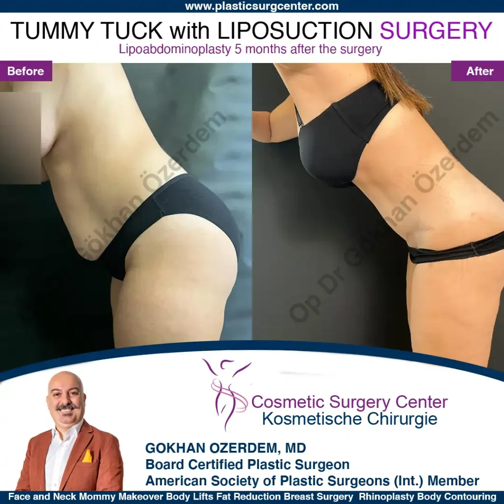 Tummy tuck in Turkey - Case 10 - Leaning Front