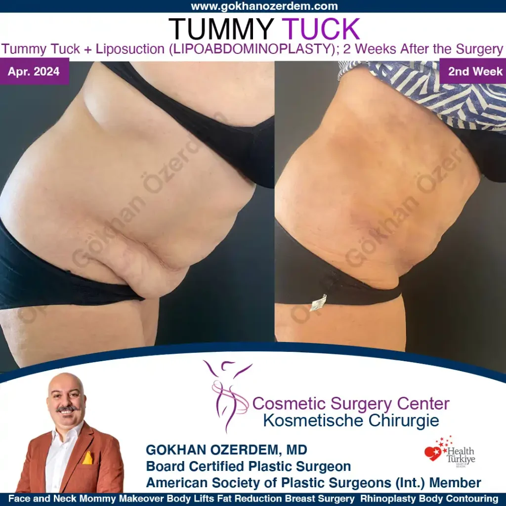 Tummy tuck in Turkey - Case 7 - Leaning Front