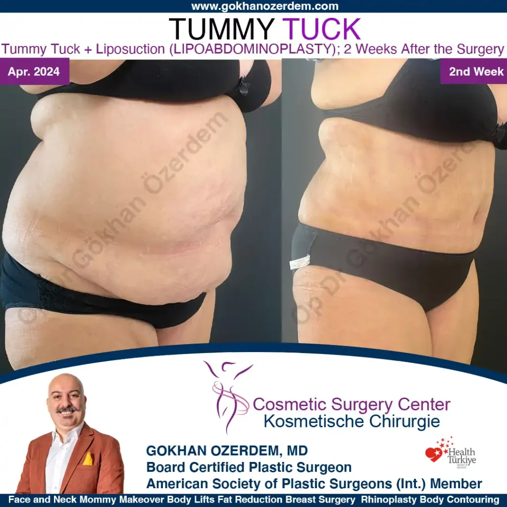 Tummy tuck in Turkey - Case 7 - Oblique View