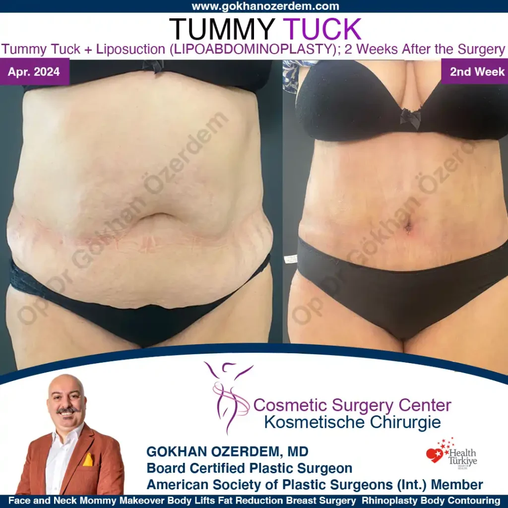 Tummy tuck in Turkey - Case 7 - Front View