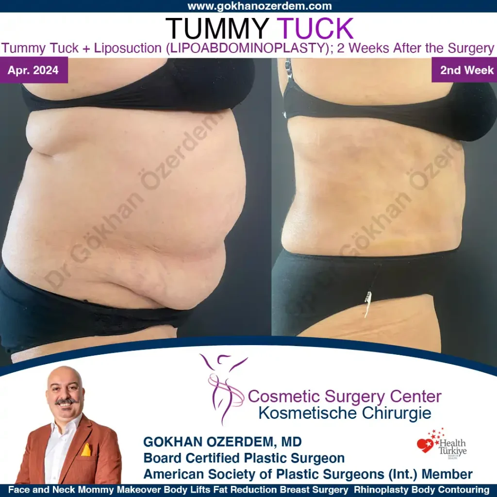 Tummy tuck in Turkey - Case 7 - Right Side