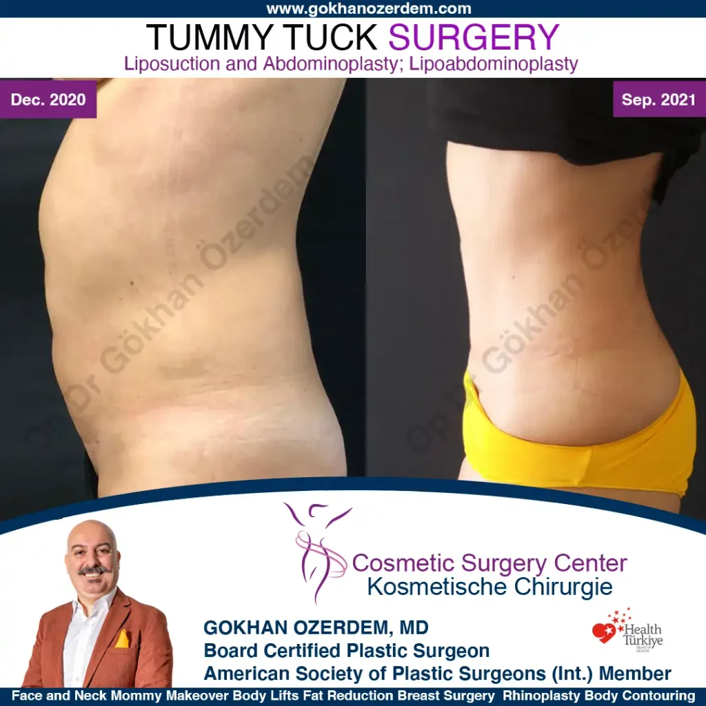 Tummy tuck in Turkey - Case 12 - left Side