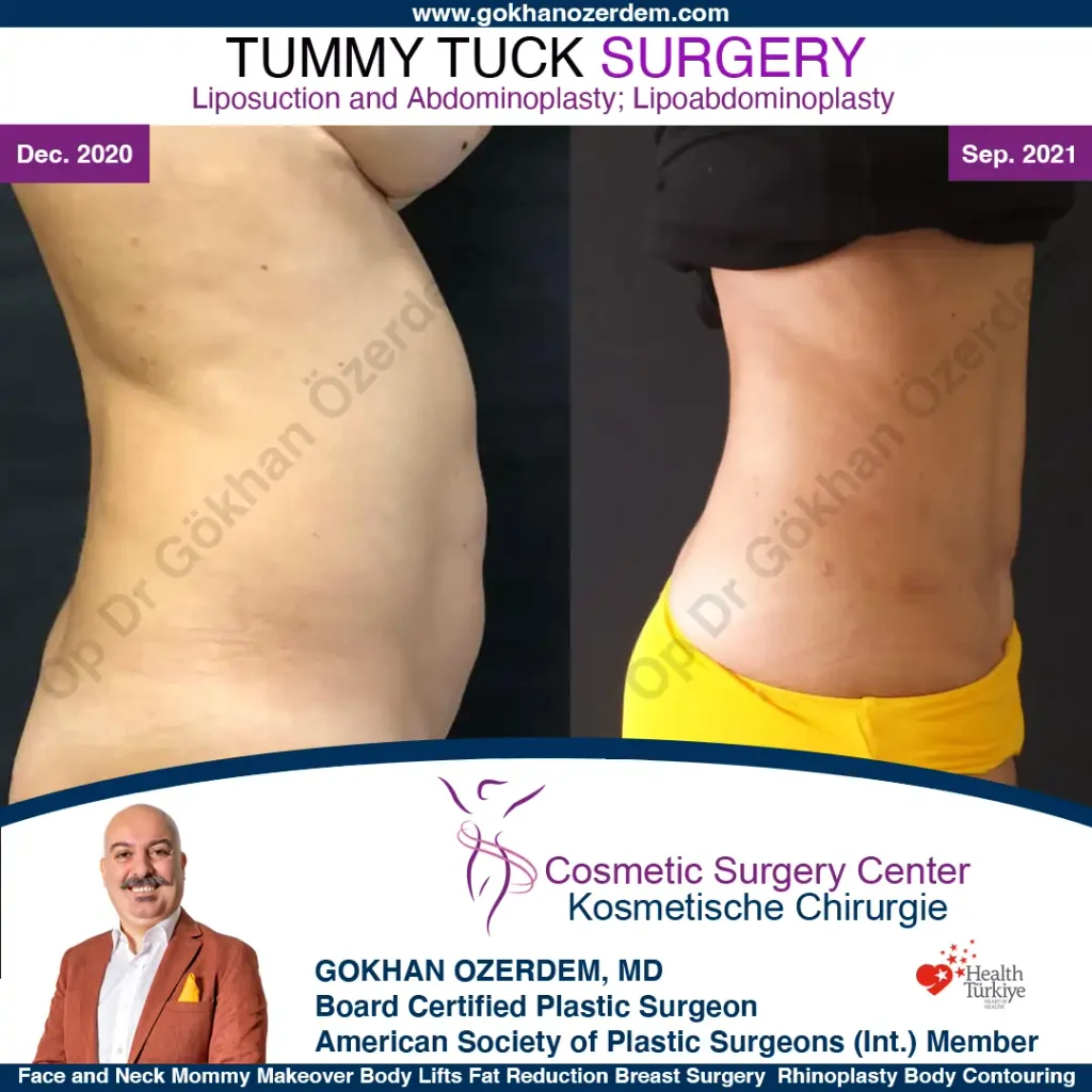 Tummy tuck in Turkey - Case 12 - Right Side
