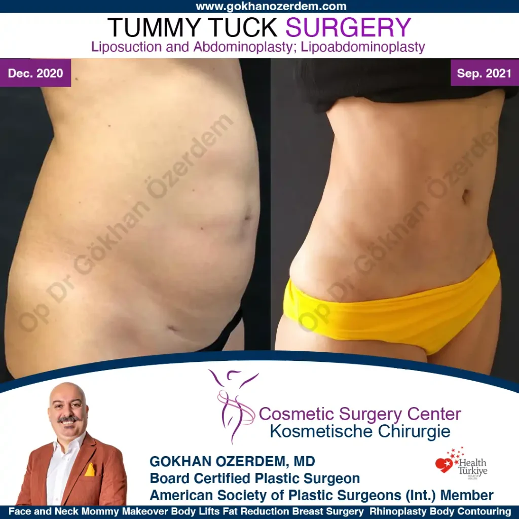 Tummy tuck in Turkey - Case 12 - Oblique View