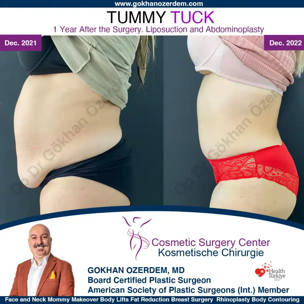 Tummy tuck in Turkey - Case 6 - Left Side