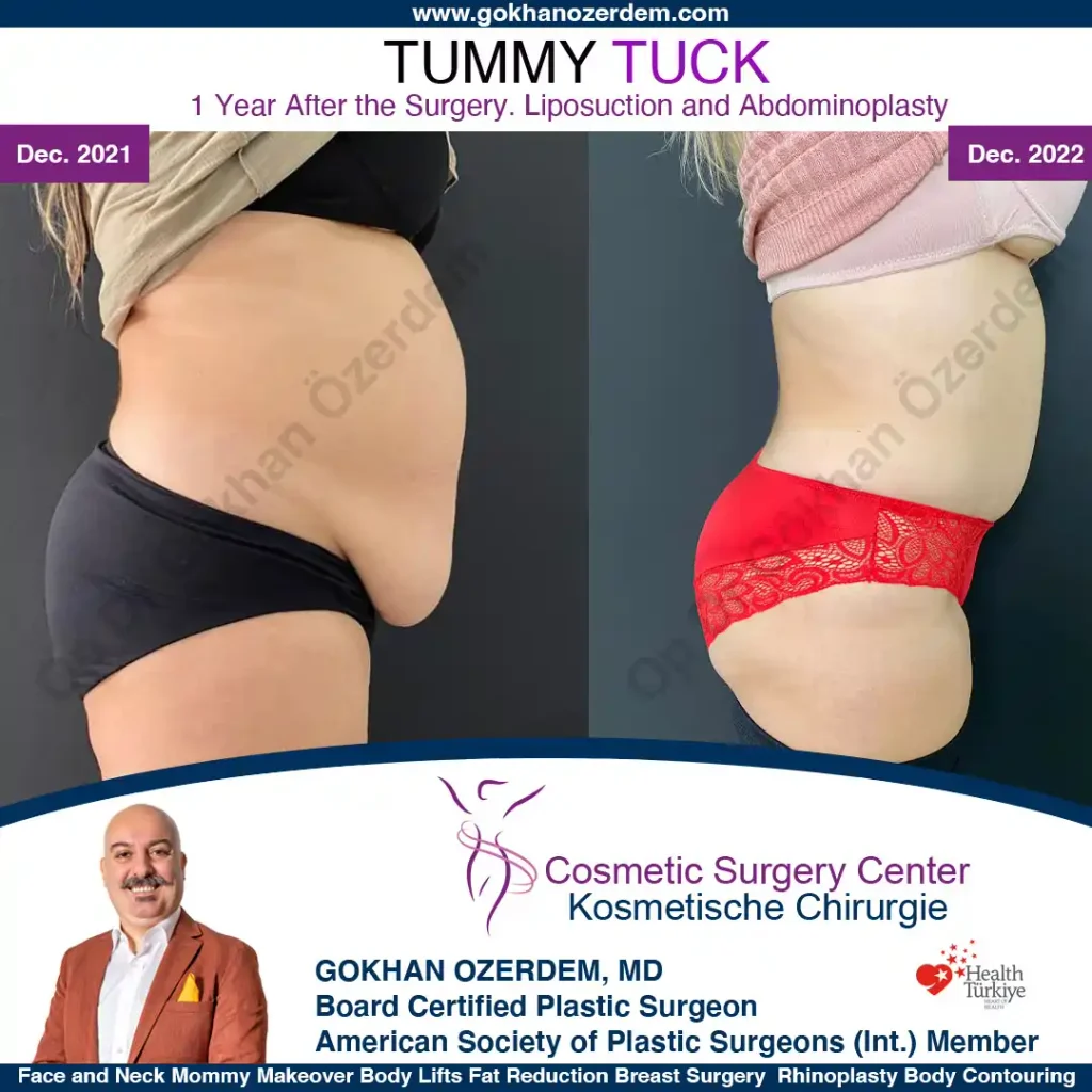 Tummy tuck in Turkey - Case 6 - Right Side