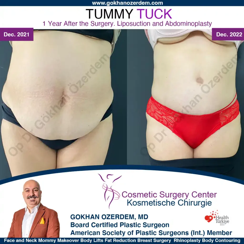 Tummy tuck in Turkey - Case 6 - Front View