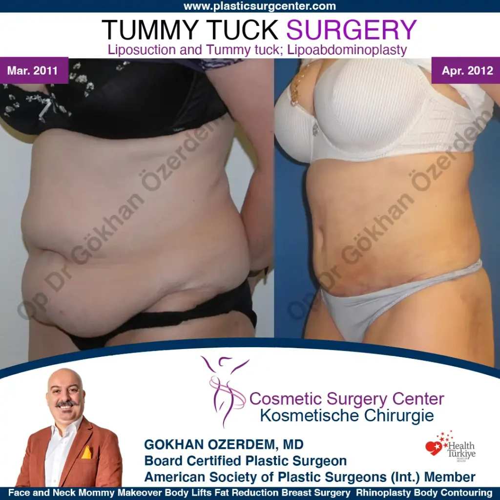 Tummy tuck in Turkey - Case 5 - Oblique View