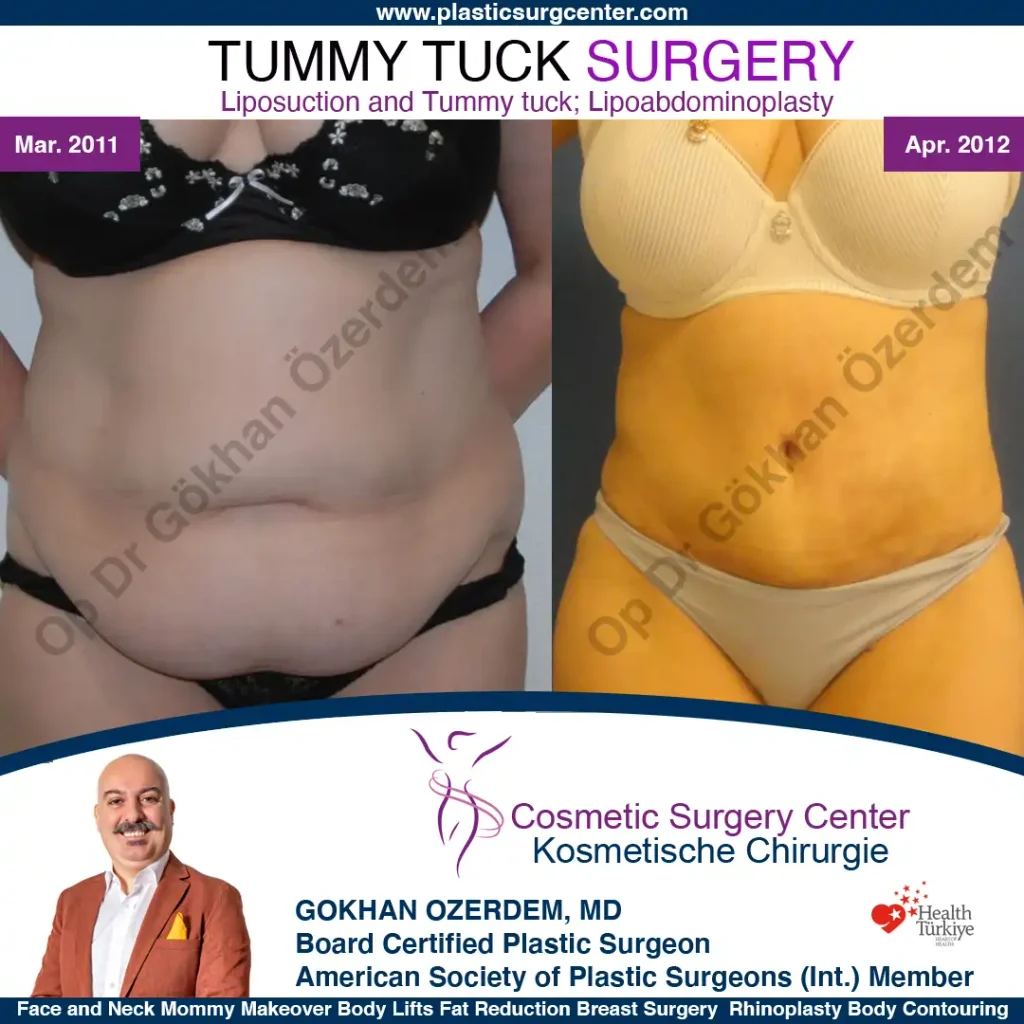 Tummy tuck in Turkey - Case 5 - Front View