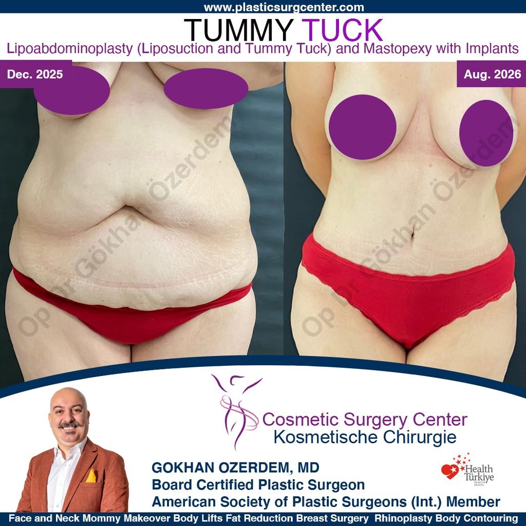 Tummy tuck in Turkey - Case 13 - Front Side - Breast Lift