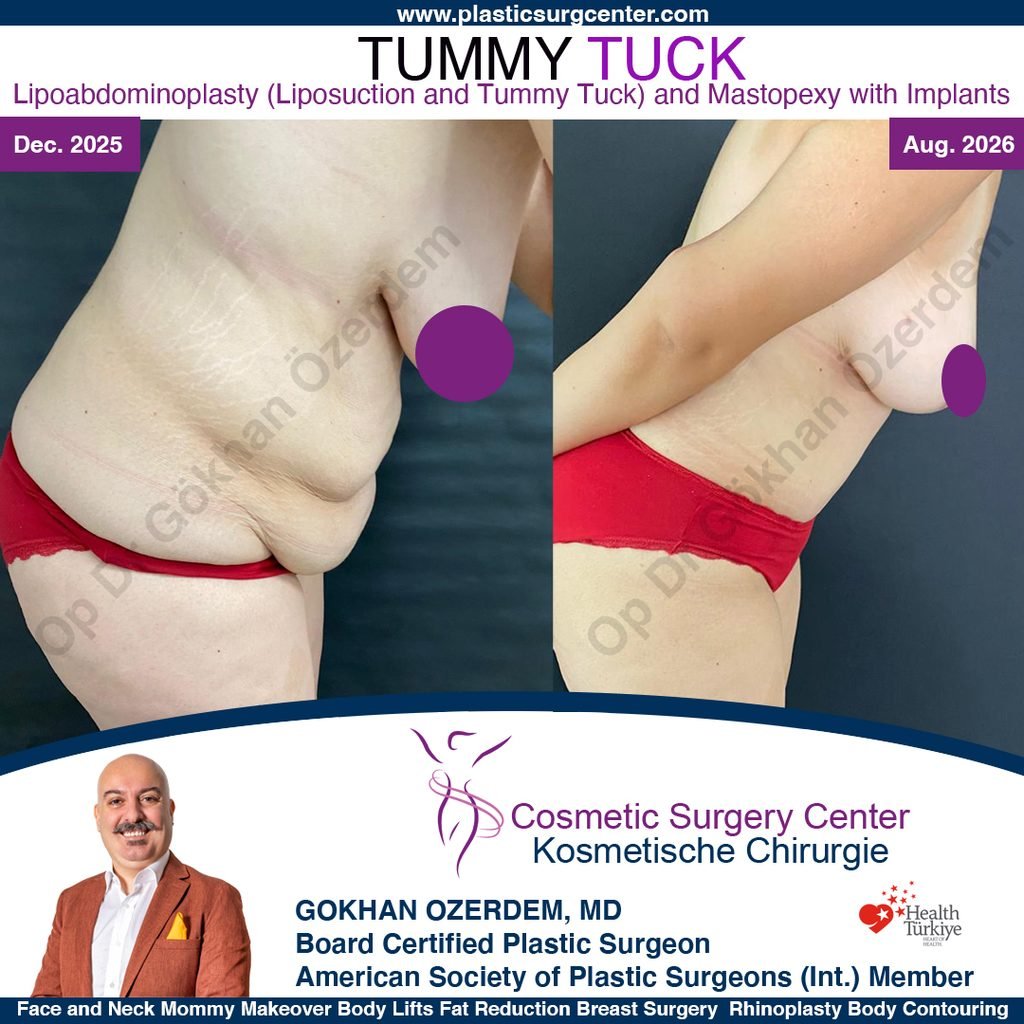 Tummy tuck in Turkey - Case 13 - Breast Lift - Leaning Forward