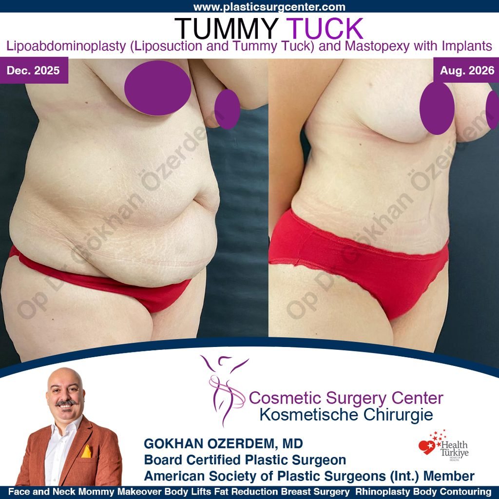 Tummy tuck in Turkey - Case 13 - Oblique View - Breast Lift