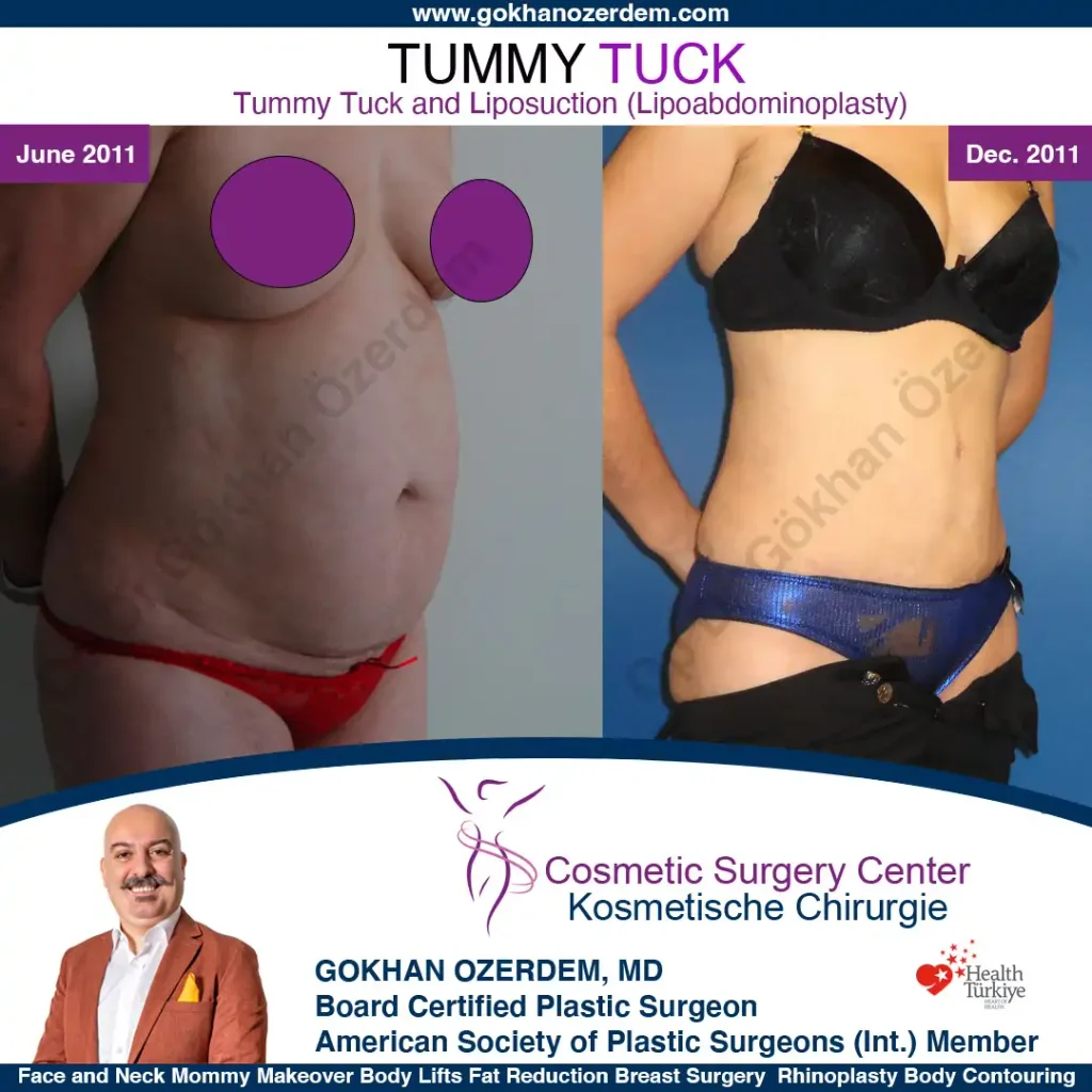 Tummy tuck in Turkey - Case 4 - Oblique View