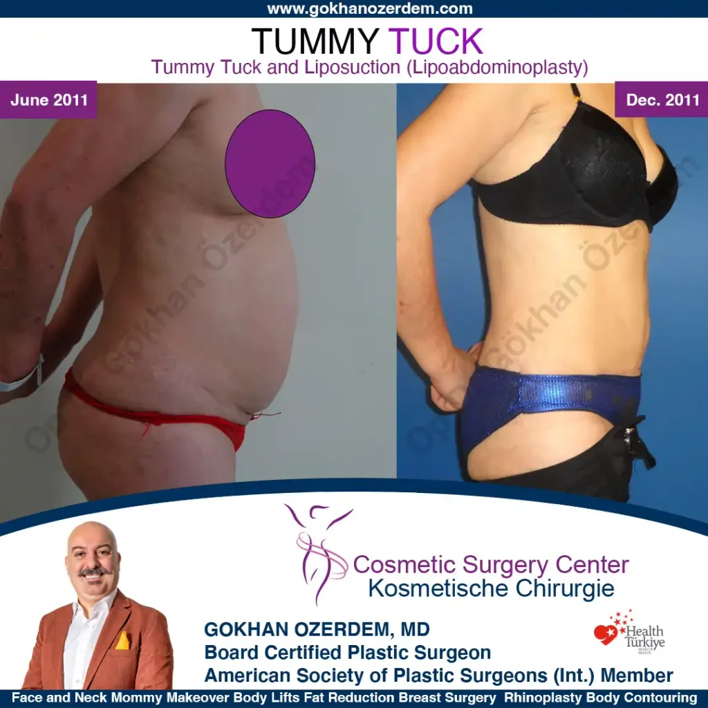 Tummy tuck in Turkey - Case 4 - Right Side