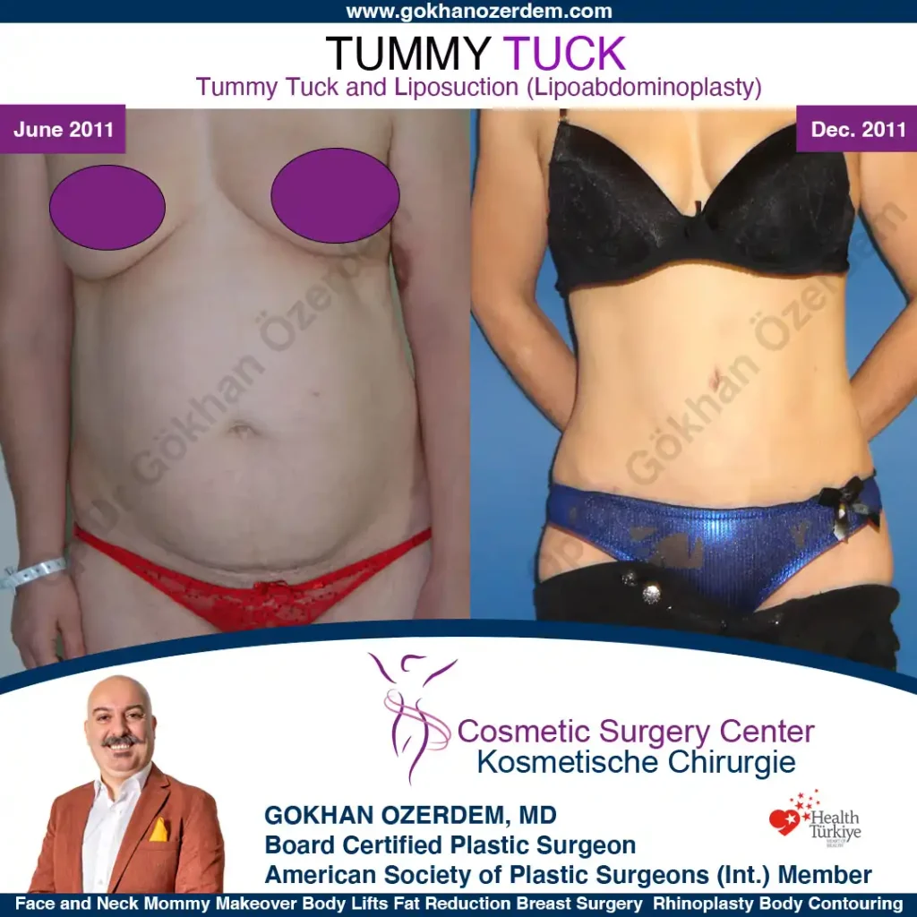 Tummy tuck in Turkey - Case 4 - Front View