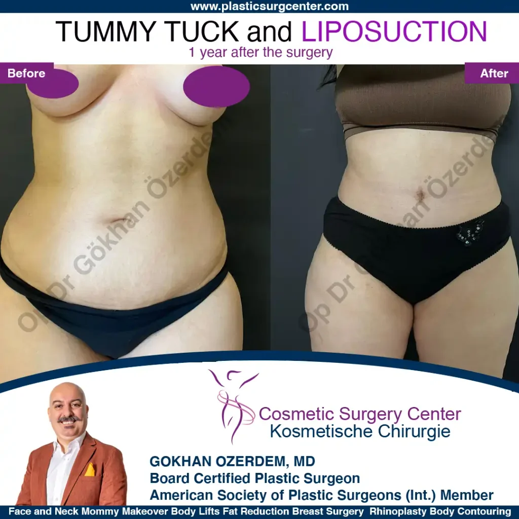 Tummy tuck in Turkey - Case 3 - Front View