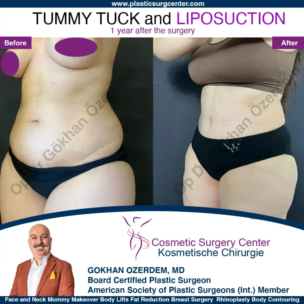 Tummy tuck in Turkey - Case 3 - Oblique View