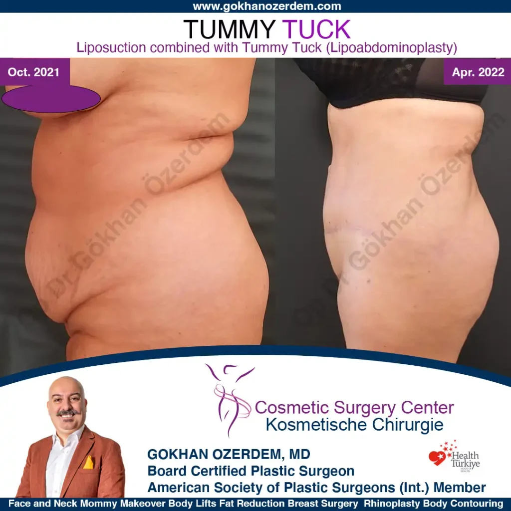 Tummy tuck in Turkey - Case 2 - Left Side