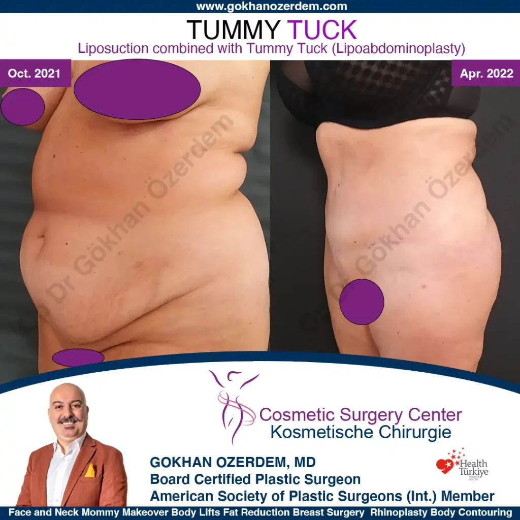 Tummy tuck in Turkey - Case 2 - Oblique View
