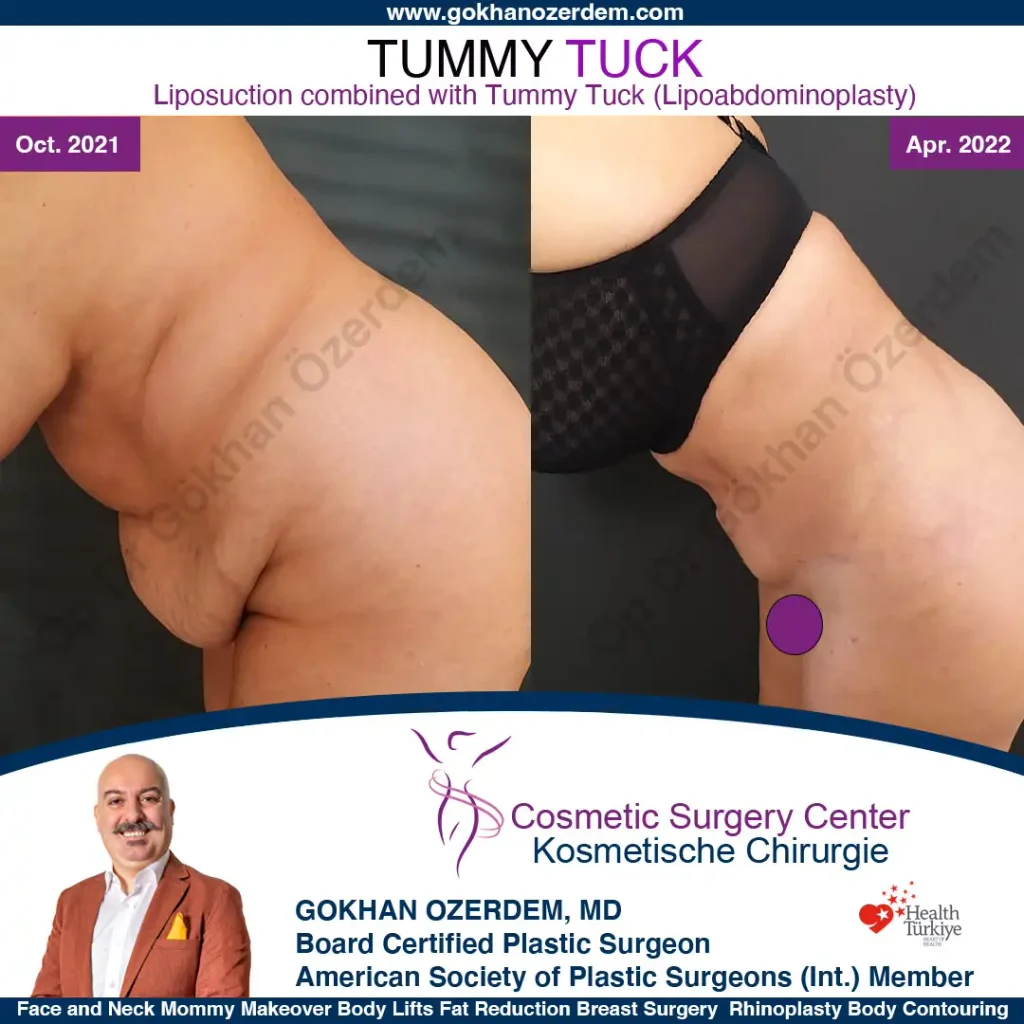 Tummy tuck in Turkey - Case 2 - Leaning Front